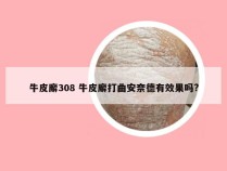 牛皮廨308 牛皮廨打曲安奈德有效果吗?