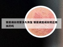 银屑病白斑要多久恢复 银屑病变成白斑还用抹药吗