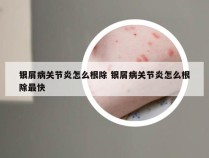 银屑病关节炎怎么根除 银屑病关节炎怎么根除最快