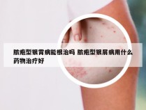 脓疱型银霄病能根治吗 脓疱型银屑病用什么药物治疗好