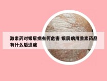 激素药对银屑病有何危害 银屑病用激素药品有什么后遗症