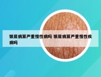 银屑病算严重慢性病吗 银屑病算严重慢性疾病吗