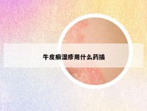 牛皮癣湿疹用什么药插