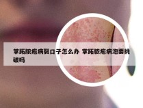 掌跖脓疱病裂口子怎么办 掌跖脓疱病泡要挑破吗