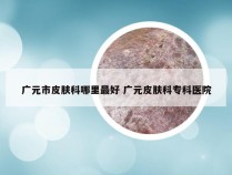 广元市皮肤科哪里最好 广元皮肤科专科医院