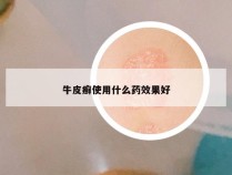 牛皮癣使用什么药效果好