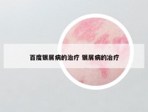 百度银屑病的治疗 银屑病的冶疗