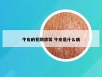 牛皮的初期症状 牛皮是什么病