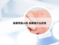 血癣传染人吗 血癣用什么药膏