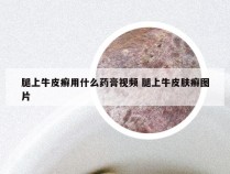 腿上牛皮癣用什么药膏视频 腿上牛皮肤癣图片