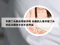 手摸了头癣会传染手吗 头癣的人用手碰了头然后又摸孩子会不会传染