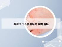 癣属于什么菌引起的 癣是菌吗