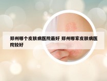 郑州哪个皮肤病医院最好 郑州哪家皮肤病医院较好