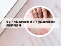 孩子下巴红红的像癣 孩子下巴红红的像癣可以擦护臀膏吗