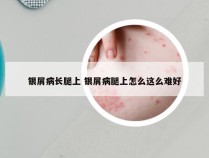 银屑病长腿上 银屑病腿上怎么这么难好