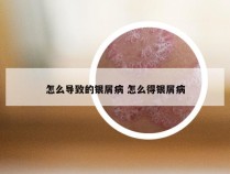 怎么导致的银屑病 怎么得银屑病