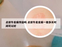 点状牛皮癣传染吗 点状牛皮皮癣一般多长时间可以好