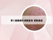 掌砋胧胞病不间断复发 掌脓疱症