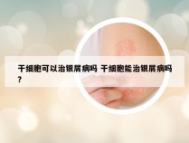 干细胞可以治银屑病吗 干细胞能治银屑病吗?