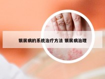 银屑病的系统治疗方法 银屑病治理