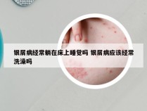 银屑病经常躺在床上睡觉吗 银屑病应该经常洗澡吗