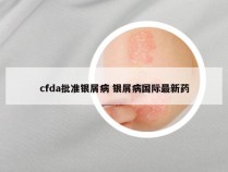 cfda批准银屑病 银屑病国际最新药