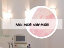 大腿内测起癣 大腿内侧起藓