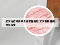 武汉治疗银屑病去哪家医院好 武汉看银屑病推荐医生