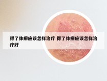 得了体癣应该怎样治疗 得了体癣应该怎样治疗好