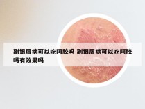 副银屑病可以吃阿胶吗 副银屑病可以吃阿胶吗有效果吗