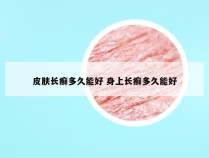 皮肤长癣多久能好 身上长癣多久能好