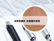 白斑灵图片 白斑图片症状