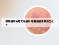 银屑病发热是艾滋病吗 银屑病患者发烧怎么办