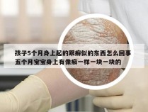 孩子5个月身上起的跟癣似的东西怎么回事 五个月宝宝身上有像癣一样一块一块的