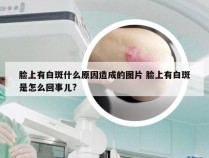 脸上有白斑什么原因造成的图片 脸上有白斑是怎么回事儿?