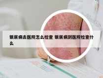 银屑病去医院怎么检查 银屑病到医院检查什么