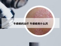 牛癖癣的冶疗 牛癖癣用什么药