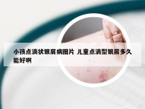 小孩点滴状银屑病图片 儿童点滴型银屑多久能好啊