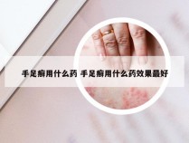 手足癣用什么药 手足癣用什么药效果最好