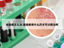 顽固癣怎么治 顽固癣用什么药才可以根治啊