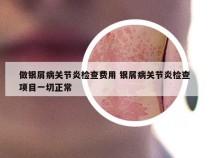 做银屑病关节炎检查费用 银屑病关节炎检查项目一切正常