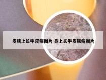 皮肤上长牛皮癣图片 身上长牛皮肤癣图片