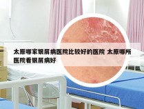 太原哪家银屑病医院比较好的医院 太原哪所医院看银屑病好