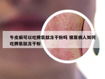 牛皮癣可以吃脾氨肽冻干粉吗 银屑病人如何吃脾氨肽冻干粉