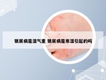 银屑病是湿气重 银屑病是寒湿引起的吗