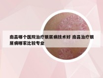 南昌哪个医院治疗银屑病技术好 南昌治疗银屑病哪家比较专业