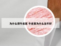 为什么得牛皮屑 牛皮屑为什么治不好