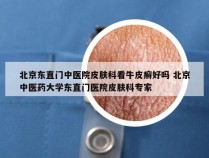 北京东直门中医院皮肤科看牛皮癣好吗 北京中医药大学东直门医院皮肤科专家