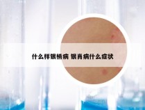 什么样银梢病 银肖病什么症状