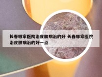 长春哪家医院治皮肤病治的好 长春哪家医院治皮肤病治的好一点